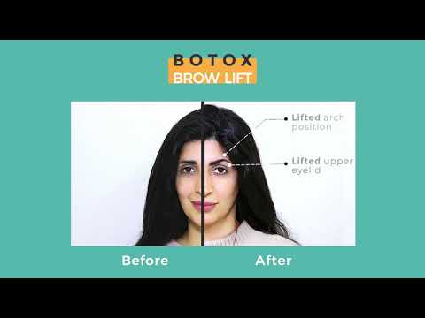 BOTOX BROW LIFT 