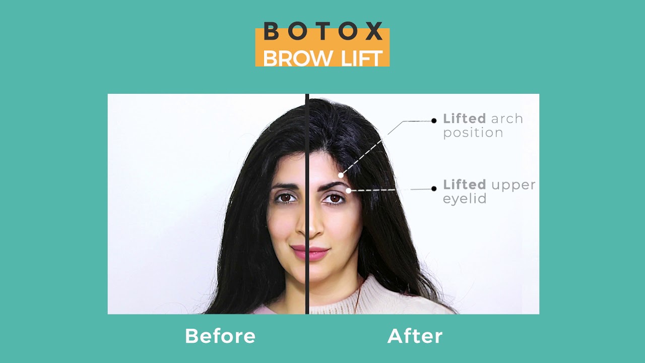 BOTOX BROW LIFT 