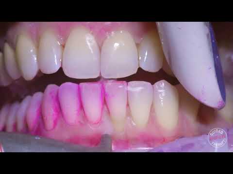 Guided Biofilm Therapy (GBT) at Burneston Dental