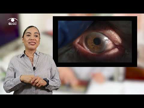 Caso de linfoma ocular