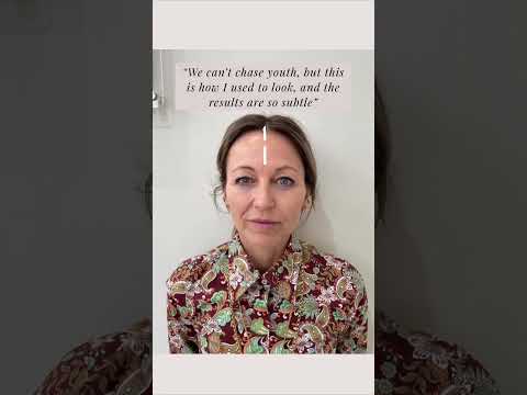 Which side has been treated with Dermal Filler