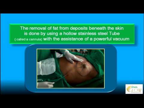Liposuction Surgery in Mumbai Call 9920366459 OR 39199022 – Dr. Vinod Vij Fortis Glow