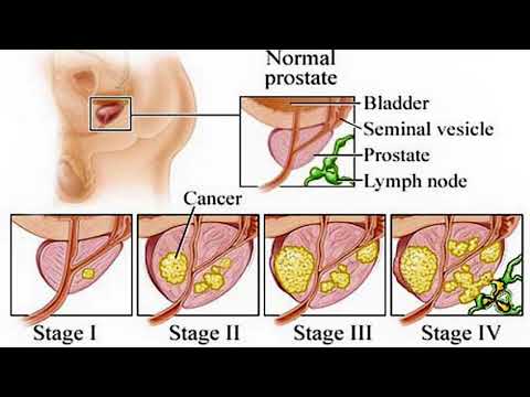 Gyertyák Prostatitis Ichthyol Vélemények