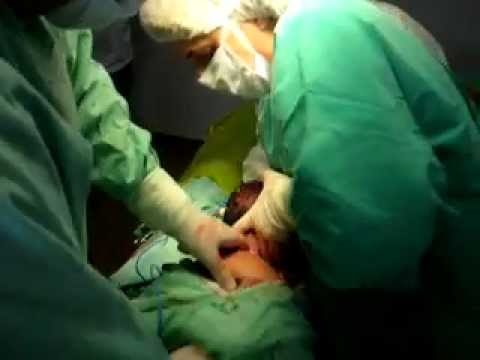 EL NACIMIENTO DE LORENZO POR CESÁREA.MOV
