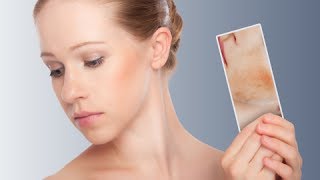 How to Get Rid of Redness on Face - Facial Redness Treatment