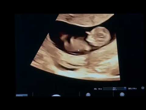 Fetus 11 weeks. Ultrasound shows movements, nasal bone, crown rump length- Dr. Kağan Kocatepe