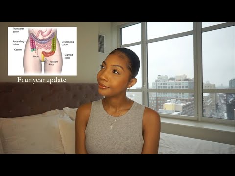 MY FOUR YEAR BREAST AUGMENTATION UPDATE | WHAT I WISH I KNEW. | FT Ana Luisa