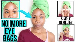 How to Get Rid of DARK EYE CIRCLES & UNDER EYE BAGS FAST & NATURALLY! | Home Remedies & More!
