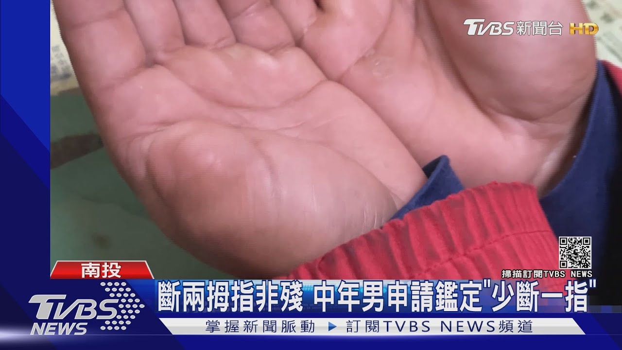斷兩拇指非殘 中年男申請鑑定「少斷一指」