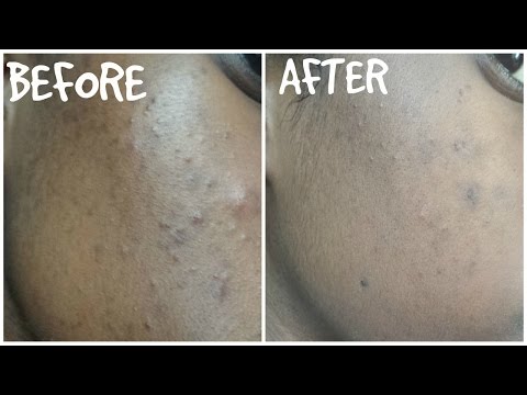 Does benzoyl peroxide really work?