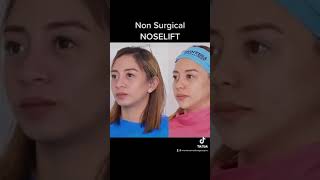 Download lagu FACIAL CONTOURING, NOSE LIFT, CHIN AUGMENTATION, CHEEK AUGMENTATION AT MONTESA MEDICAL GROUP mp3
