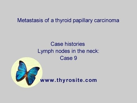 Papillary thyroid cancer with lymph node metastasis