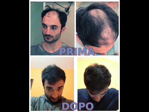 foto di Gianluca prima e dopo il trapianto capelli in Turchia