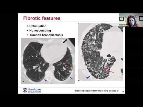 Interstitial Lung Disease for the General Internist