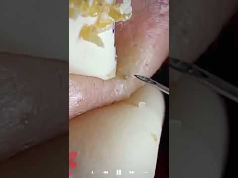 Skincare | Blackheads Removal #656 #tweezers skincare #blackheads blackheads