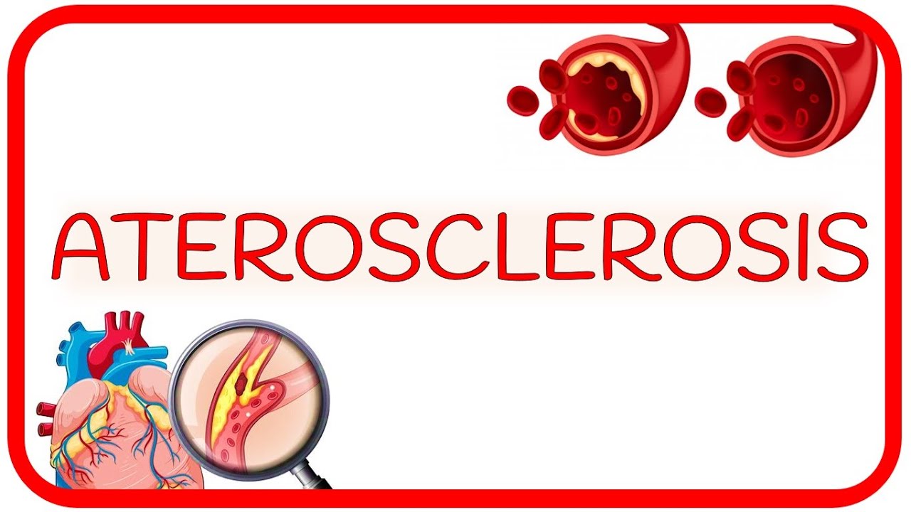 ATEROSCLEROSIS - causas, fisiopatología y factores de riesgo