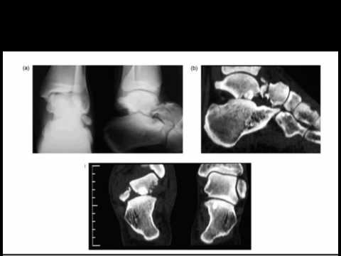 Talus Fractures