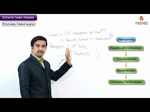 Pathology of Angina Pectoris: Prinzmetal angina,Variant angina :USMLE Step 1 coronary artery disease