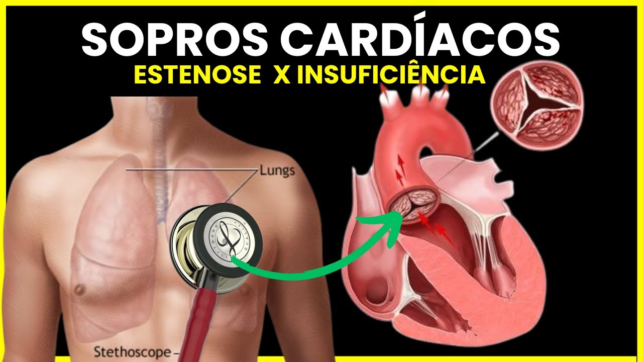 VALVULOPATIAS NA AUSCULTA CARDÍACA