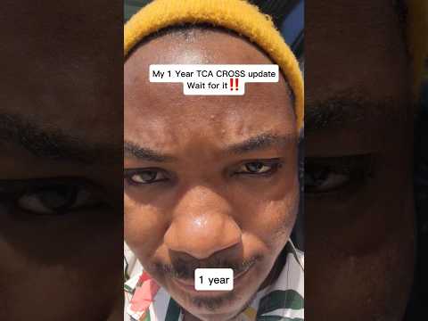 1 year TCA CROSS update #acnejourney #tcacross #tcapeel #diytcacross #tcacrossacnescarring #tca