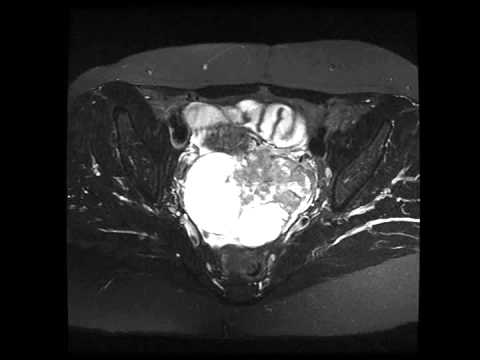 Serous carcinoma of the ovary
