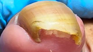 Yellow, Inflamed Ingrown Toenail; Cut Off Any Excess Nail【Xue Yidao】