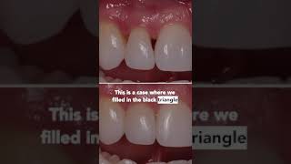 how to fix spaces in teeth? | alternatives to remove the black triangles in between teeth! #shorts