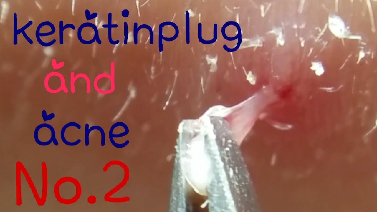 角栓抜き&ニキビ押しNo.2～I pull out keratinplug and acne No.2