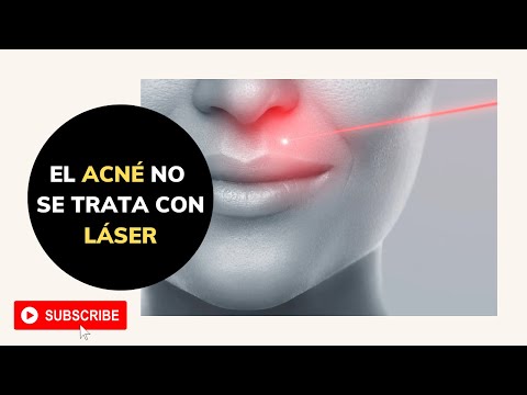 El ACNÉ NO se trata con LÁSER