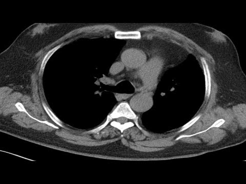 Cross sectional and imaging anatomy of the thorax