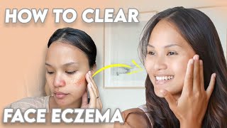 Get Rid of Facial Eczema (*life-changing tips!*)