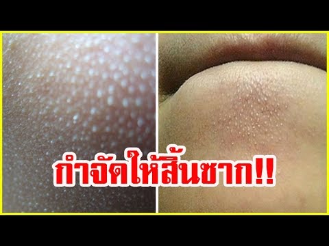 โรคสะเก็ดเงินที่ภาพข้อศอก เมล็ดยี่หร่าและโรคสะเก็ดเงิน