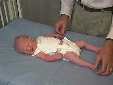 neurology exam: newborn-abnormal: Tone - Arm Recoil