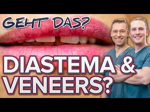 Frontzahnlücke schliessen - Smile Makeover im Oberkiefer // Diastema Lippenbändchen