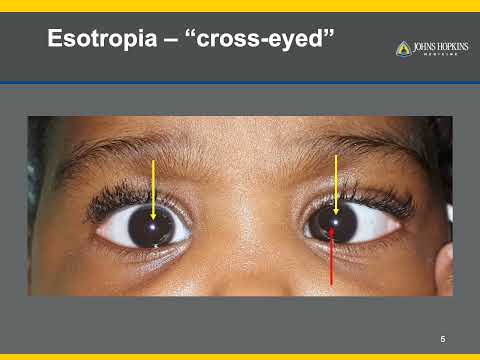 Strabismus | A Patient Guide to Misalignments of the Eyes