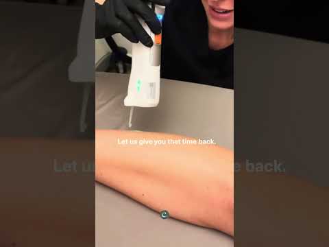 Laser hair removal results