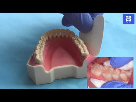 Technique for placing a resin fissure sealant