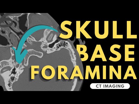 Skull Base Foramina | Radiology anatomy part 1 prep | CT imaging of skull base