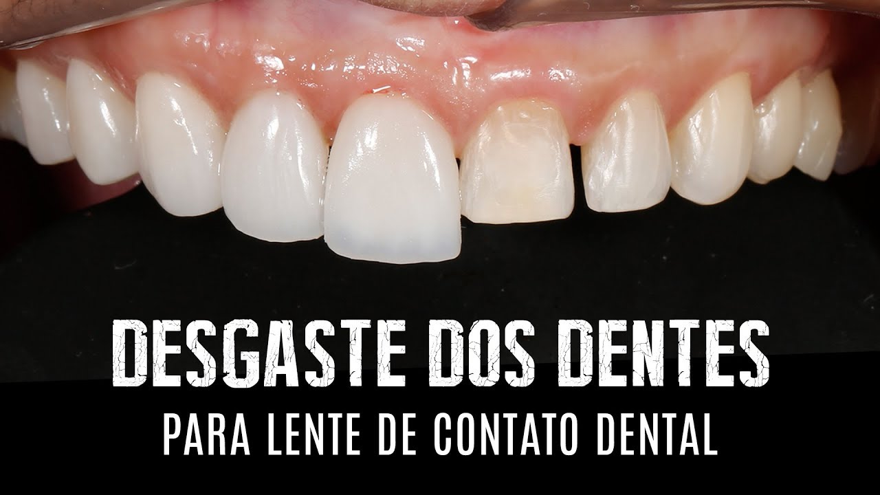 Watch Now Desgaste dos dentes para lentes de contato dentais e facetas em porcelana Desgaste dos dentes para lentes de contato dentais e facetas em porcelana
