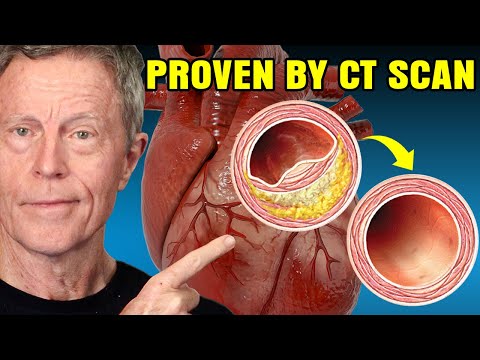 I Reversed 20 Years of Arterial Plaque... And GOT the Scan to PROVE IT