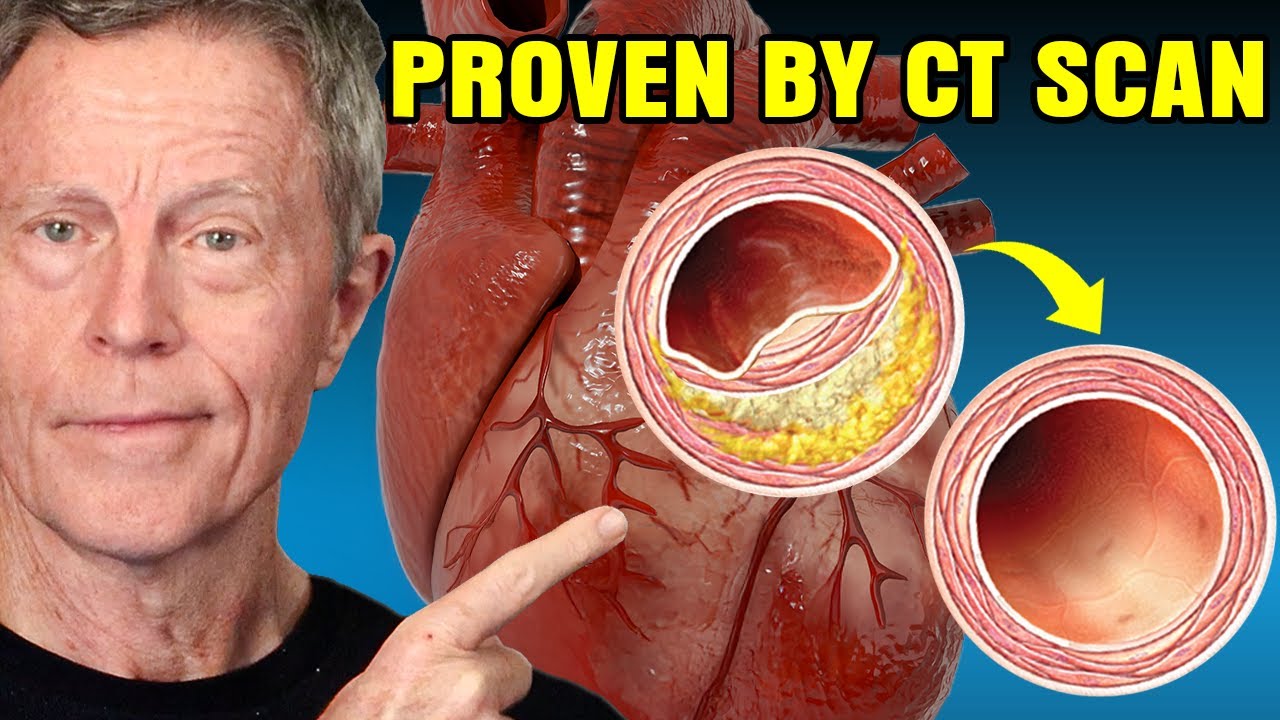 I Reversed 20 Years of Arterial Plaque... And GOT the Scan to PROVE IT