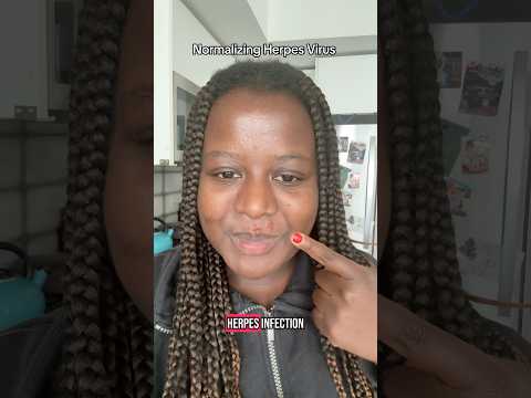 Both HSV-1 and HSV-2 can cause both oral and genital sores #doctor