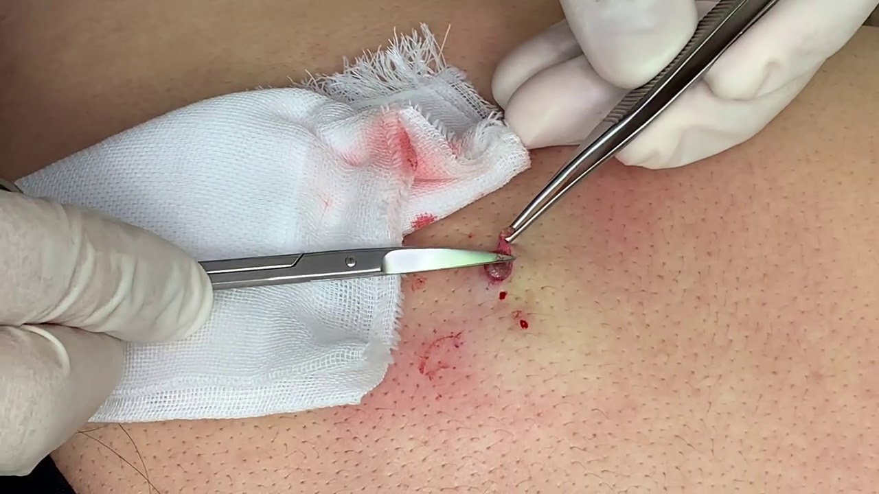 粉瘤くりぬき法　20代女性背中epidermal cyst atheroma cystic acne extractions lipoma大阪心斎橋　大阪梅田院　名古屋　福岡院　神戸西宮　尼崎　奈良