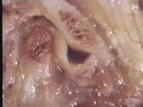 Bewegungstherapie in Hals- und Brust Osteochondrose Massage Video Uzi Gelenke Kirov Füße