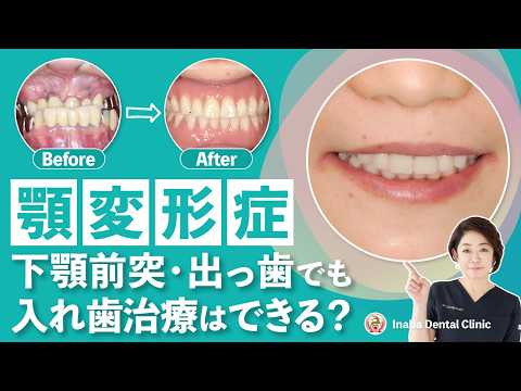 顎変形症・下顎前突・出っ歯でも入れ歯治療はできる？