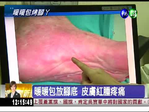 暖暖包放腳底 皮膚二度燙傷