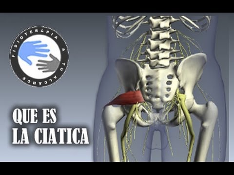 Que es la ciatica y como se produce