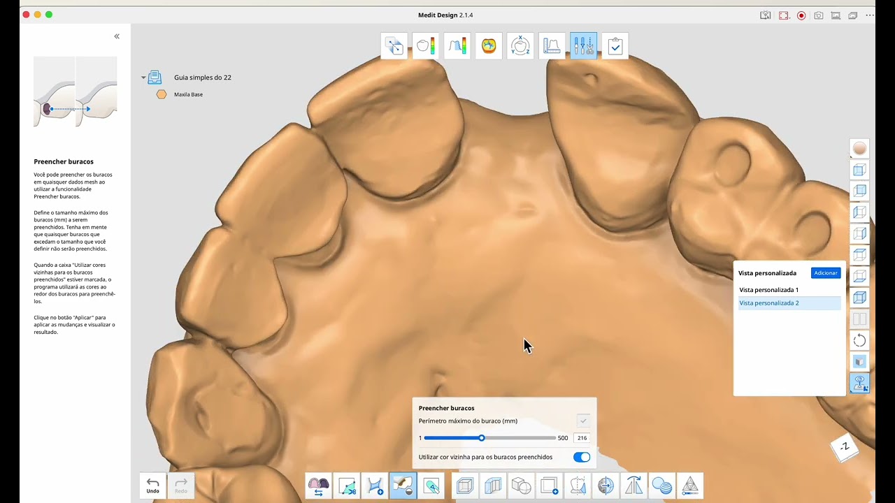 Guia simples para implante unitário