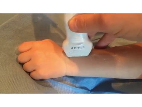 Supracondylar fractures revised