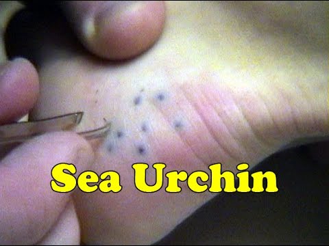 Sea Urchin Sting Removal Maui Hawaii - Daredevil Girl